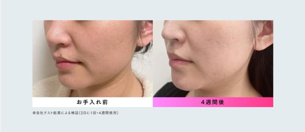 ムダ毛ケアと美肌ケアが1台でかなう！ ハイパワー光美容器「MYTREX